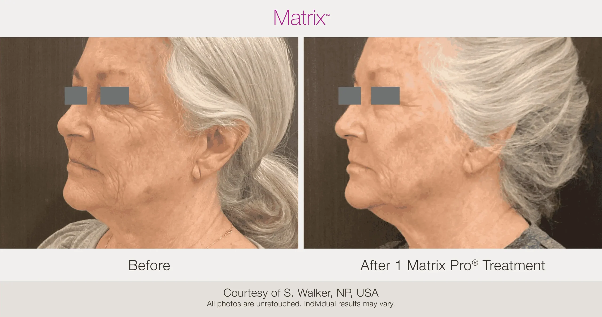 Skin Rejuvenation with Matrix-Before-After (62)