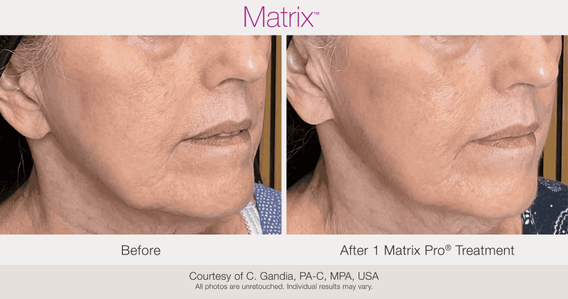 Skin Rejuvenation with Matrix-Before-After (8)
