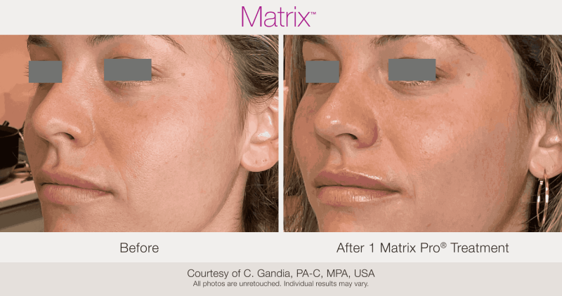 Skin Rejuvenation with Matrix-Before-After (9)